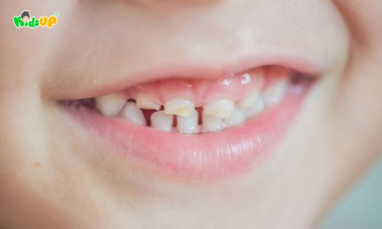 Trẻ mọc răng không đều