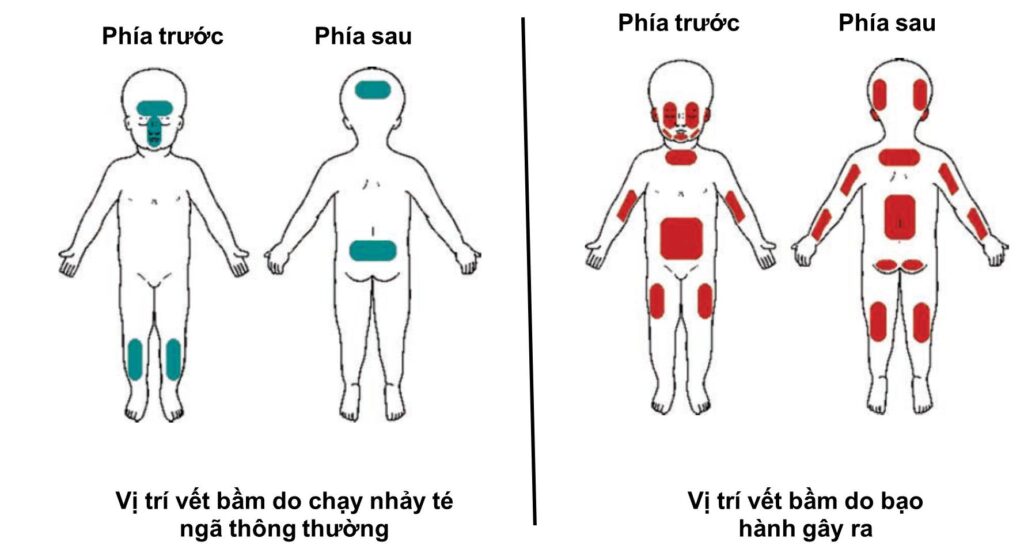 Phân biệt các vị trí bị bạo hành với các vết thương bị ngã