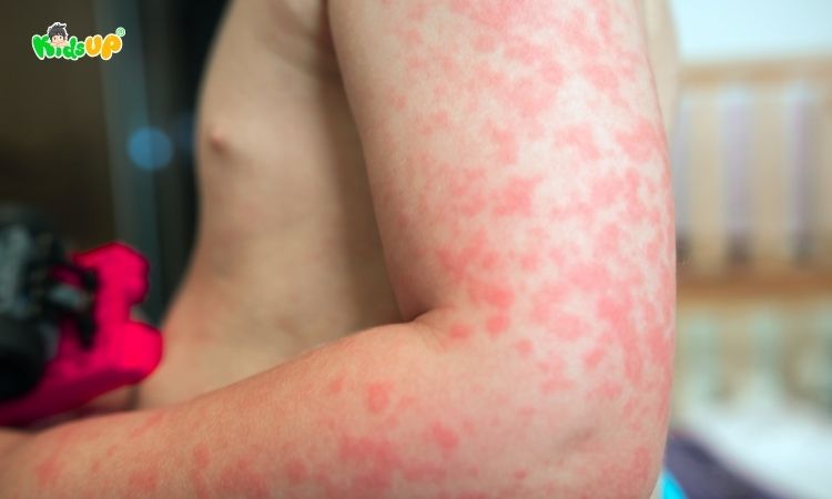 Ăn yến có thể dị ứng nhưng điều này không thực sự không phổ biến